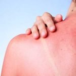 Remedies for sunburn