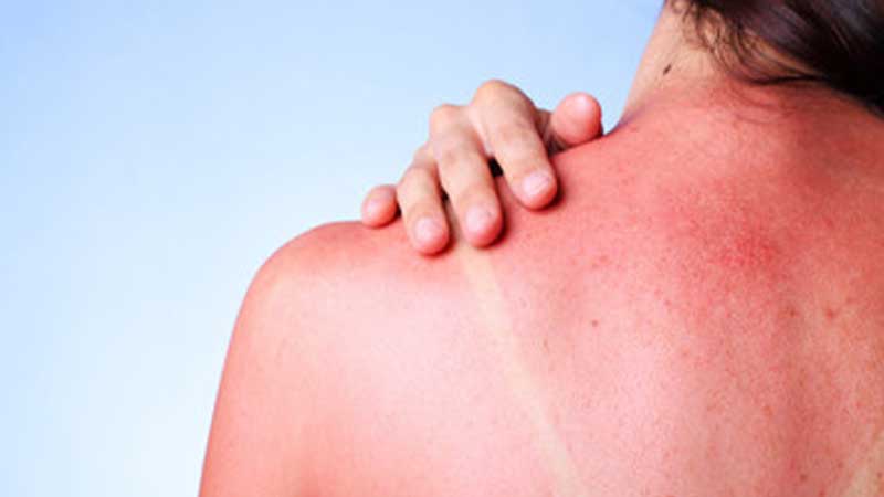 Remedies for sunburn