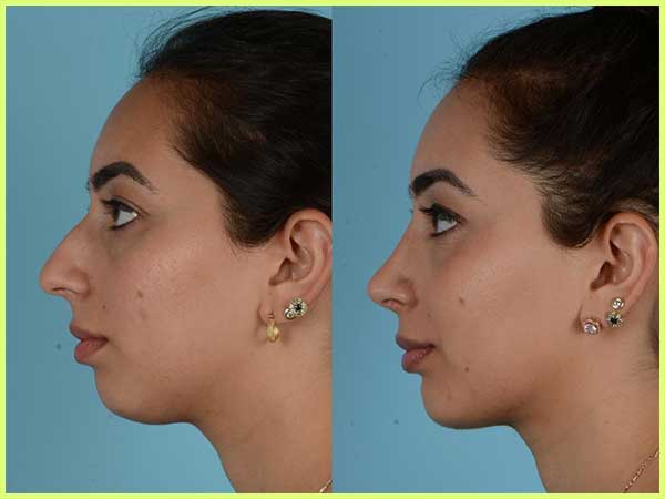 Chin liposuction before and after