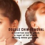 double-chin-removal